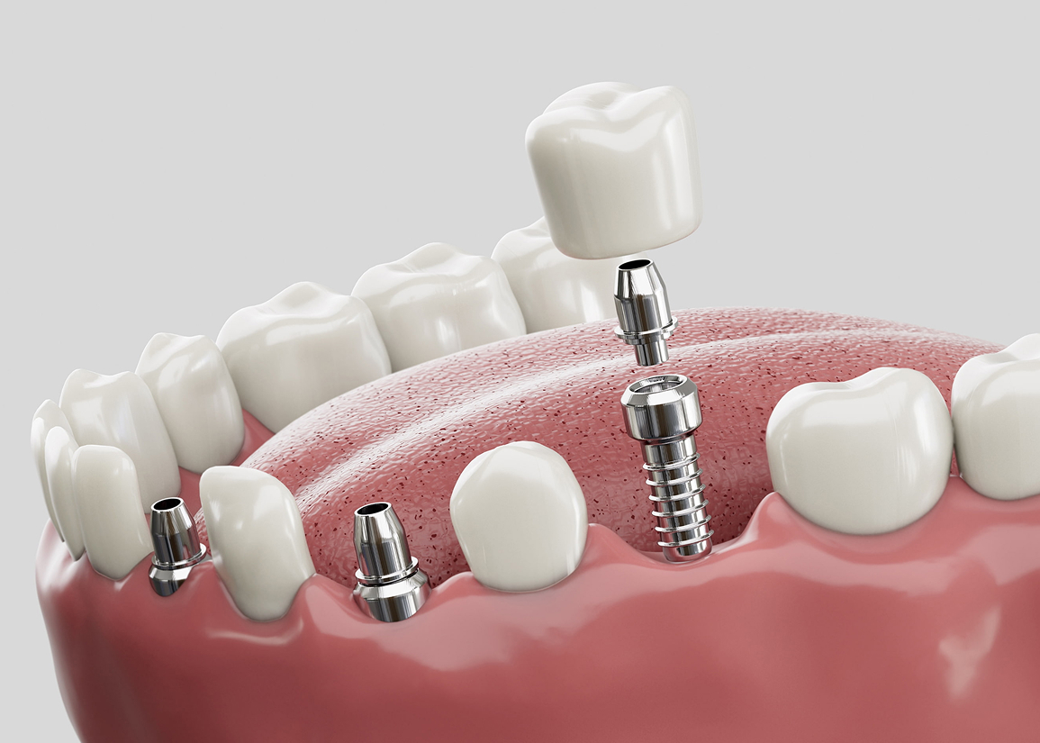 3D dental implant planning at FLOSS Dental - Delray