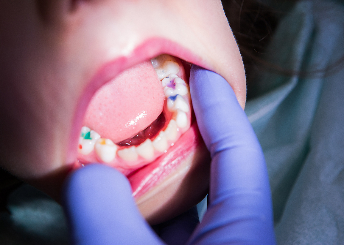 Tooth bonding cosmetic procedure at FLOSS Dental - Delray