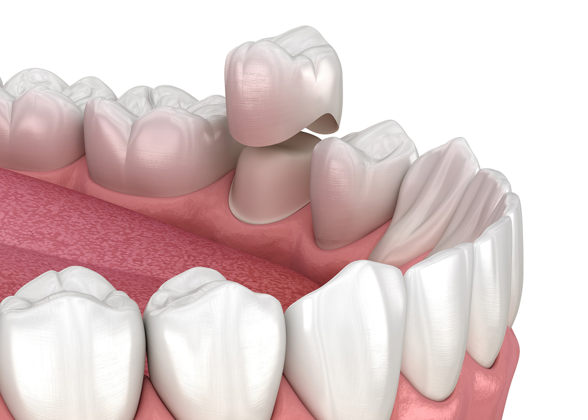 Dental crowns and bridges at FLOSS Dental - Delray