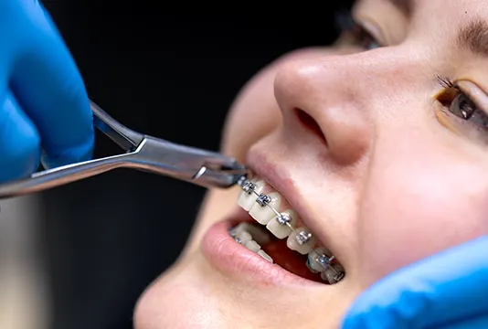 Accelerated orthodontics treatment planning at FLOSS Dental - Delray